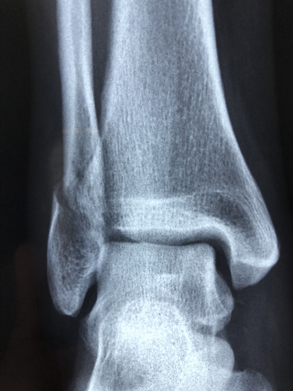 Rééducation fracture calcanéum